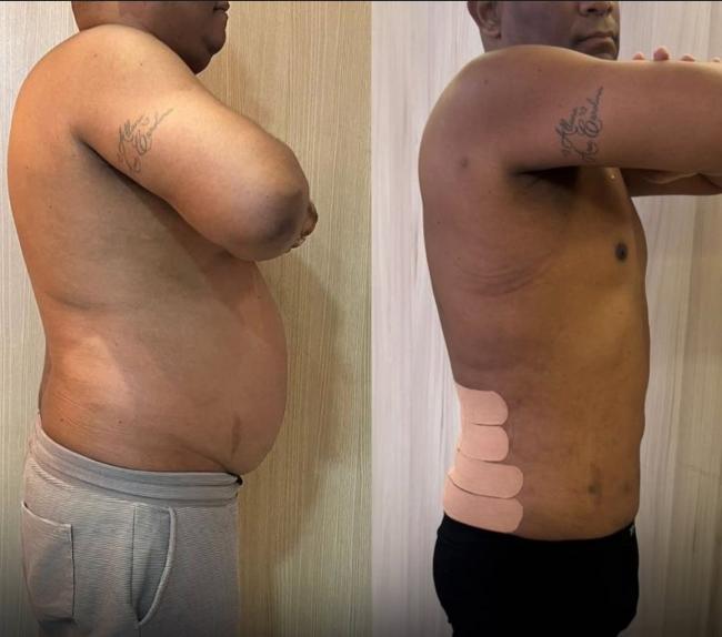 Endolaser para Lipedema