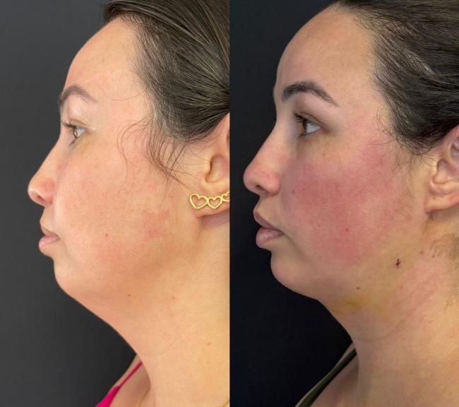  Lifting de Face e Pescoo