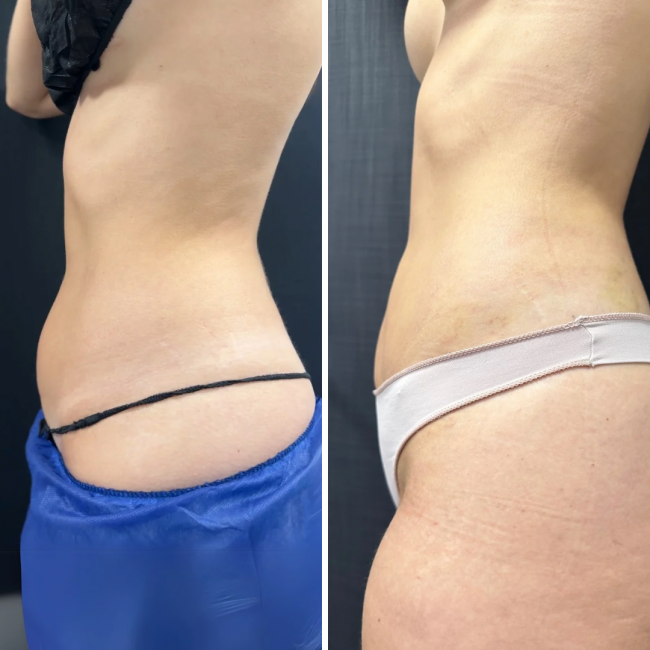 Mini extrao Lipdica Ambulatorial (MELA)