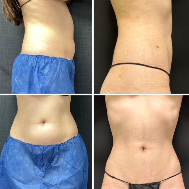 Resultado de abdmen com Dr Vicente Sposito