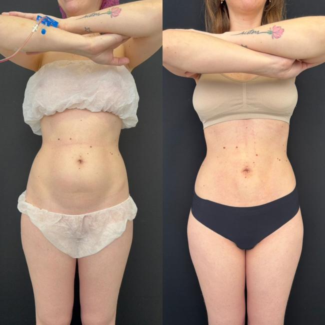 Cirurgia de abdmen com Dr Vicente Sposito