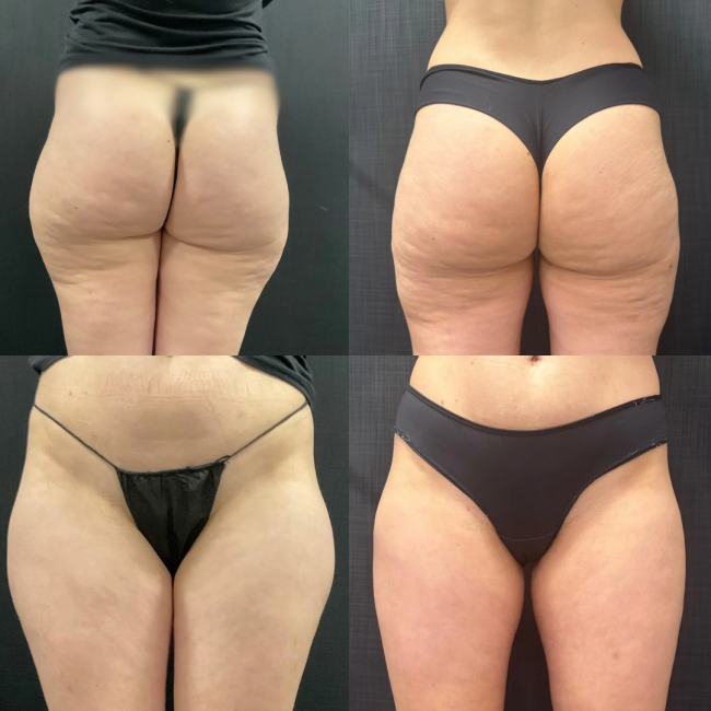 Resultado Antes e Depois cirurgia com Dr Vicente Sposito